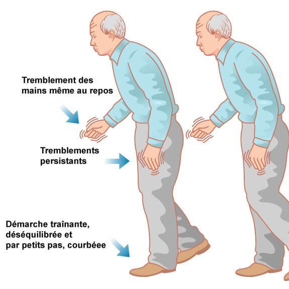 La Maladie De Parkinson : Généralités Et Traitements - Ordoscopie.fr